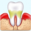 Современные методы лечения заболеваний пародонта