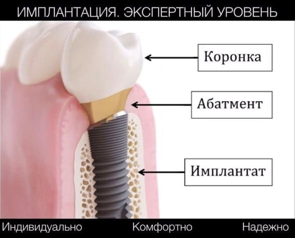 Коронка, абатмент, имплантат